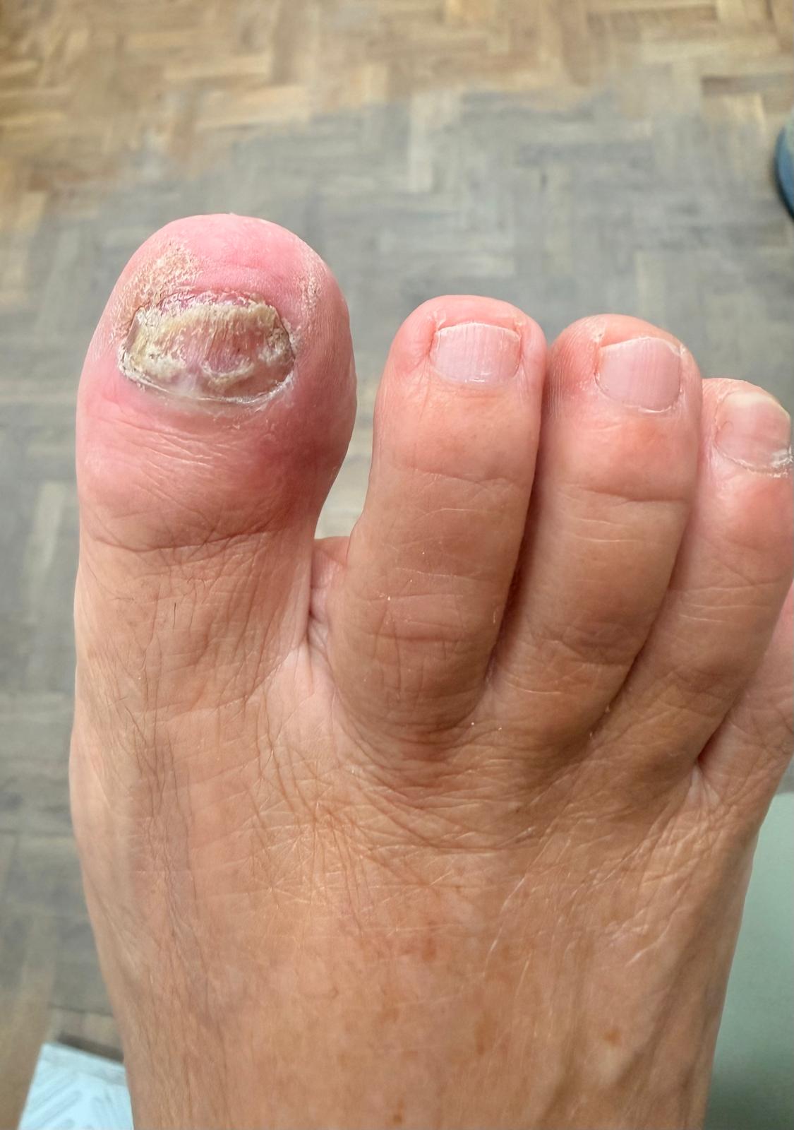 Uña con alteraciones compatibles con onicomicosis valorada en la clínica