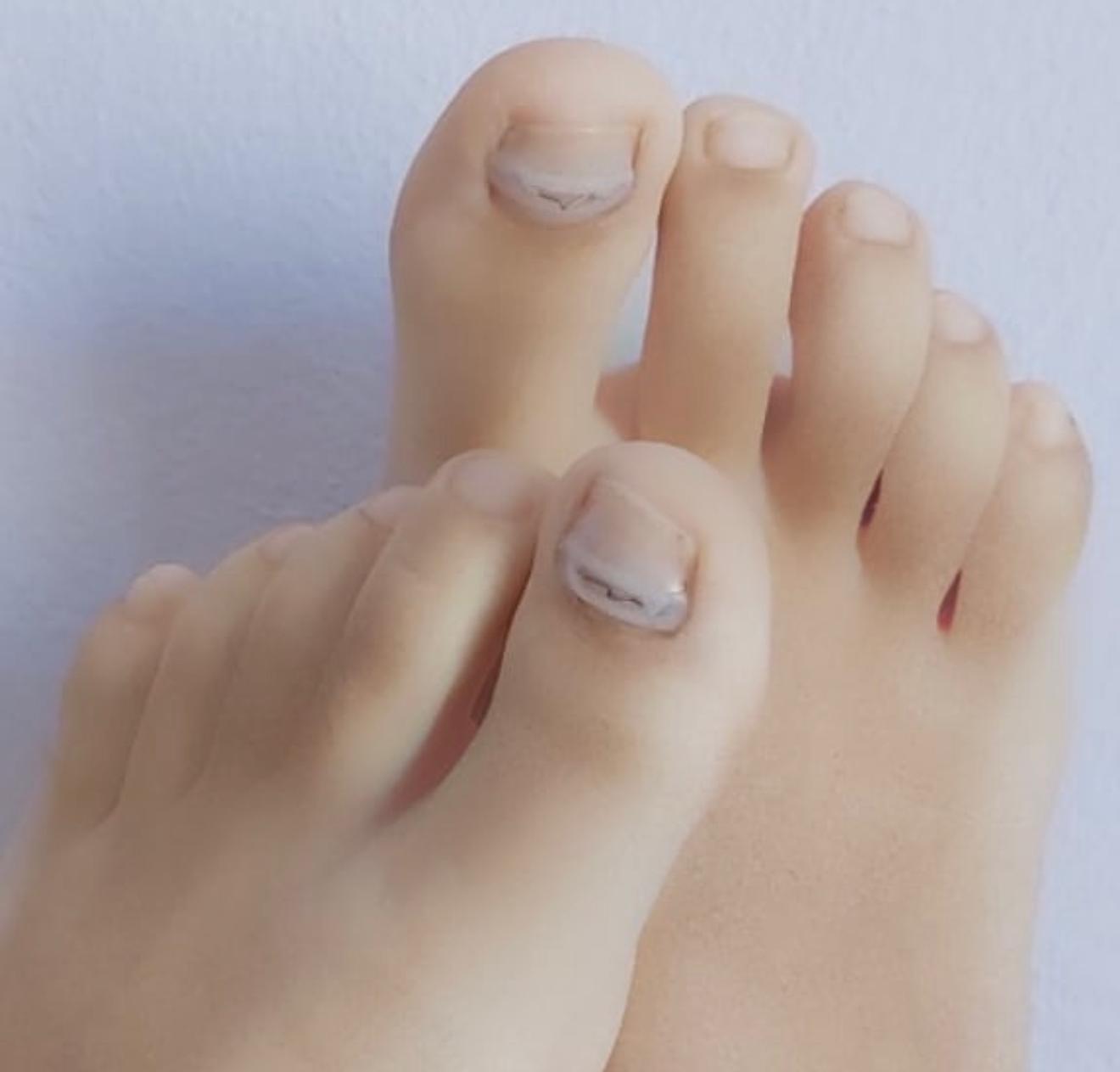 Sistemas de ortonixia colocados sobre las uñas