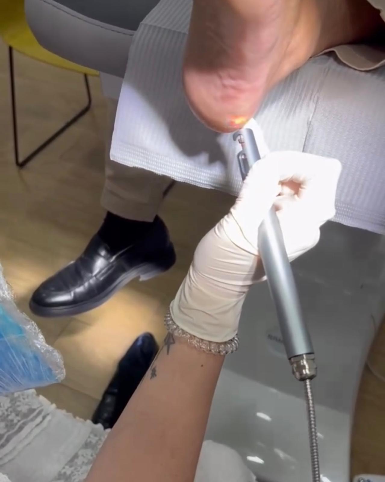 Aplicación de láser para tratar un papiloma plantar