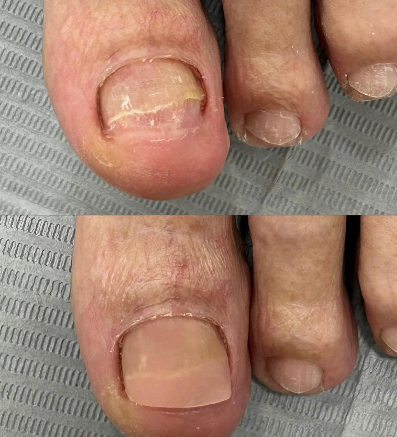 Comparativa antes y después de una reconstrucción ungueal realizada en la clínica